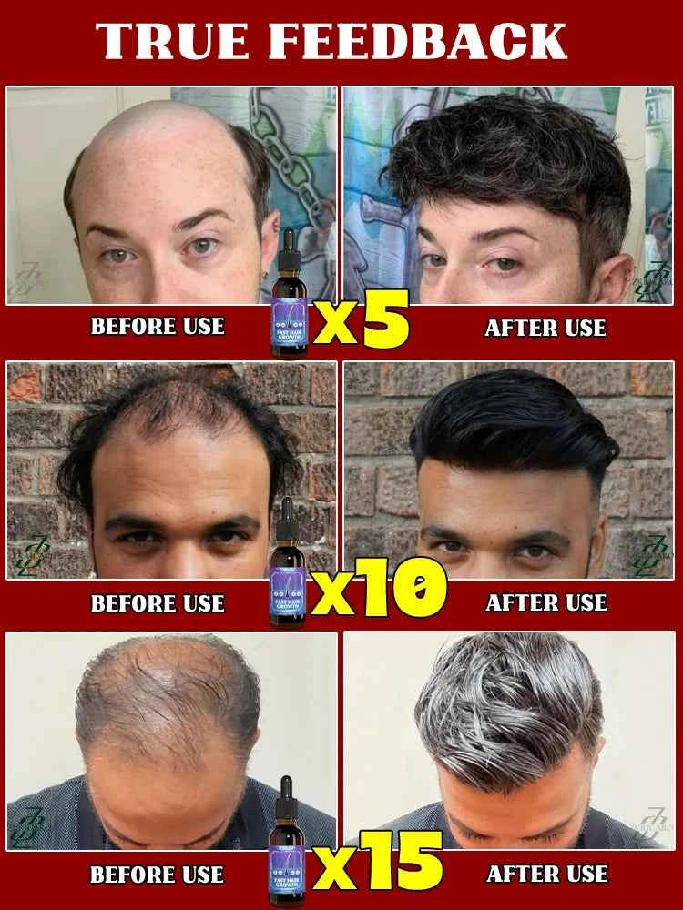 ZKRICARO 0fficial genuine, high quality hair growth essence 0il, scalp care, make hair grow thicker, no more baIIdness