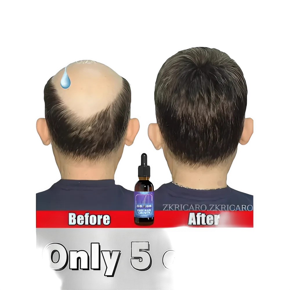 ZKRICARO 0fficial genuine, high quality hair growth essence 0il, scalp care, make hair grow thicker, no more baIIdness